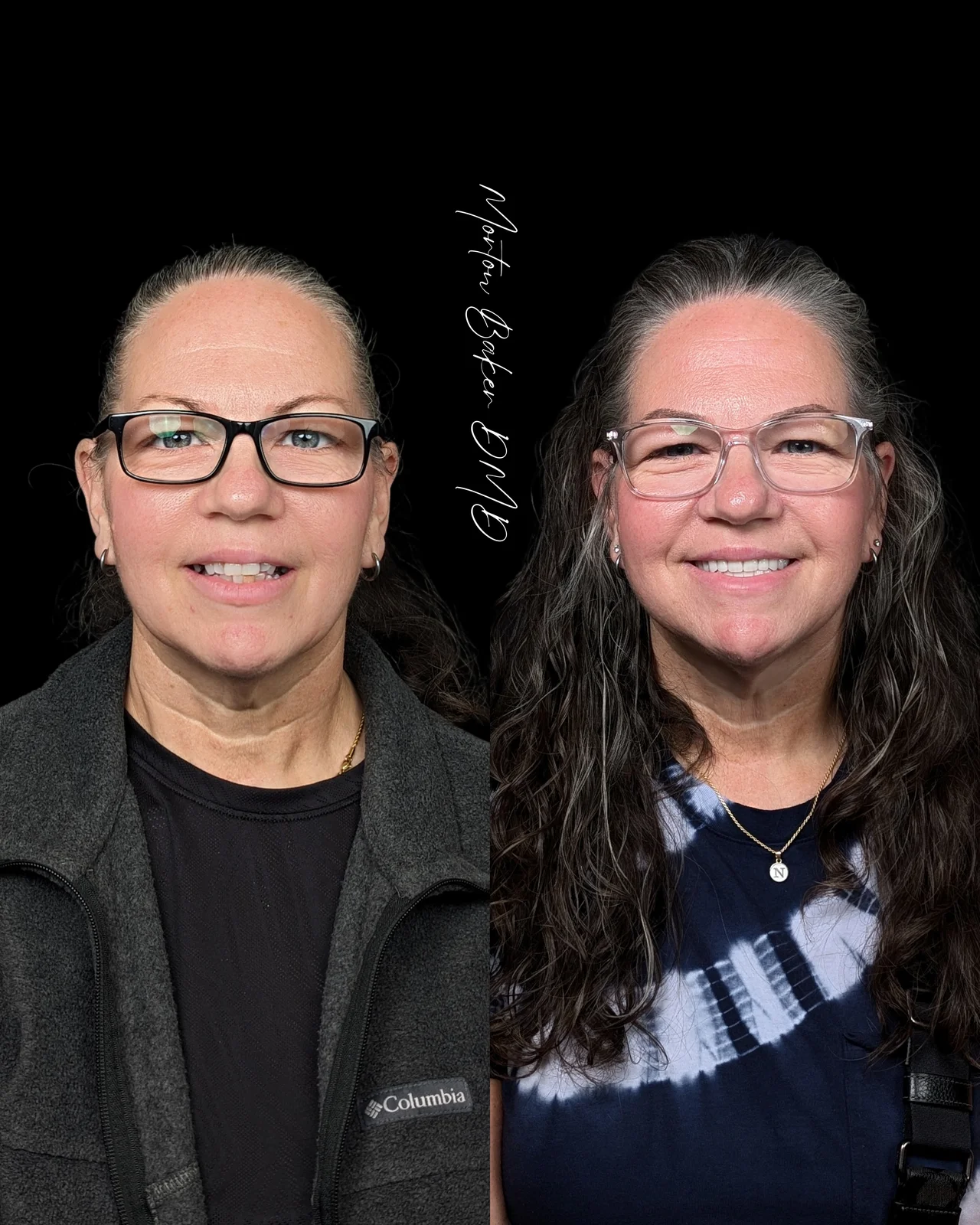 A real Dr. Baker patient before and after fixed implant teeth