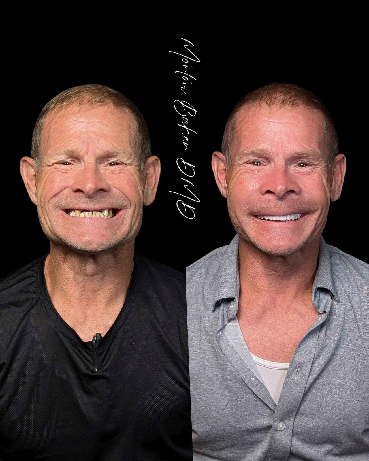 Gary's denture results
