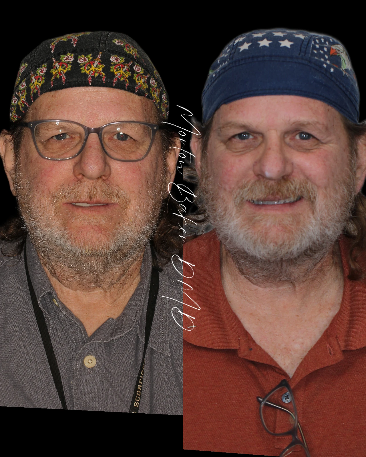 A real patient before and after snap-in denture teeth