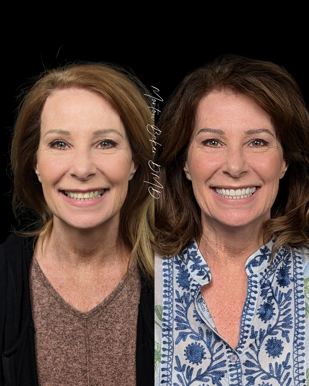 A real Dr. Baker patient before and after her new smile