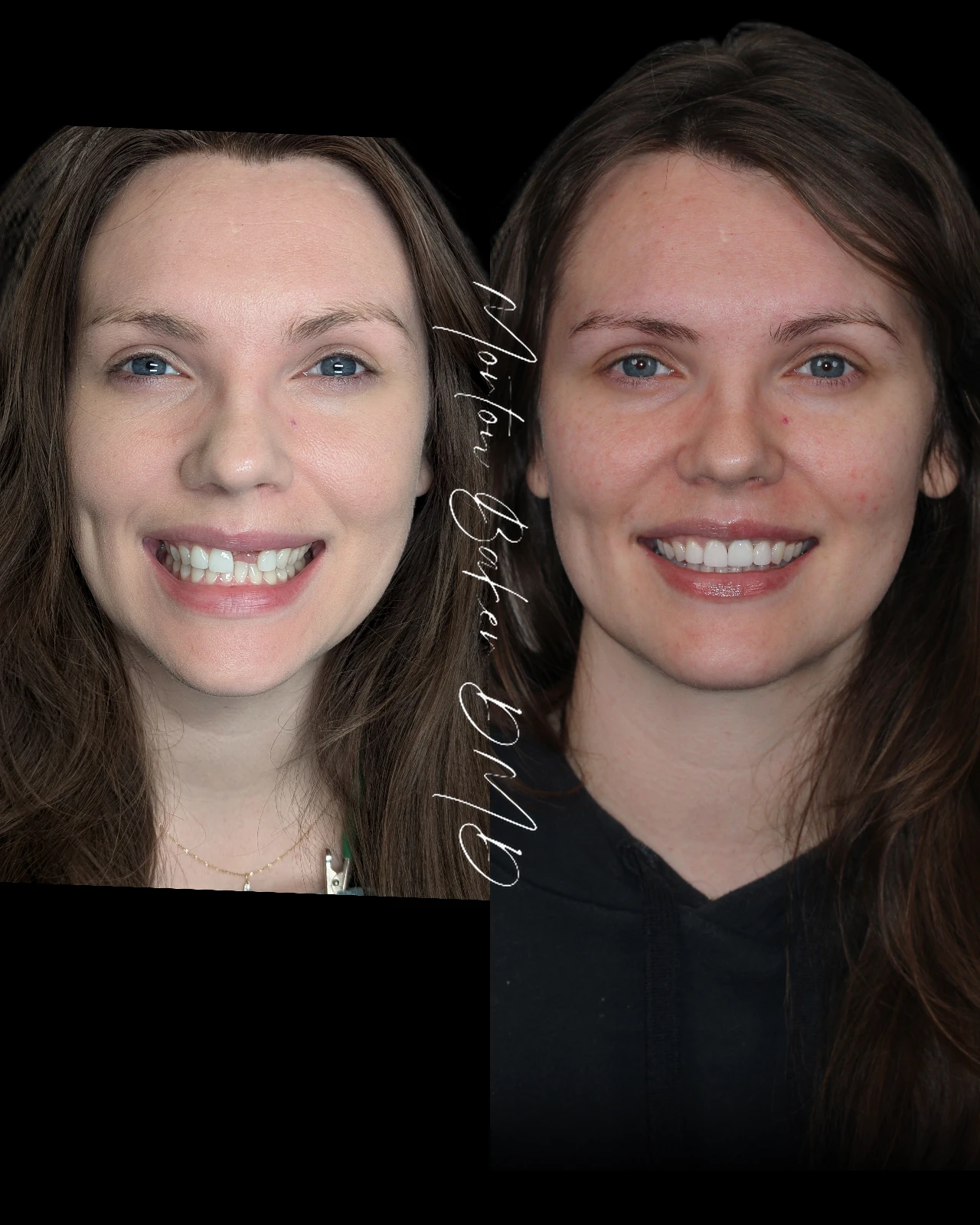 A real patient before and after an individual dental implant